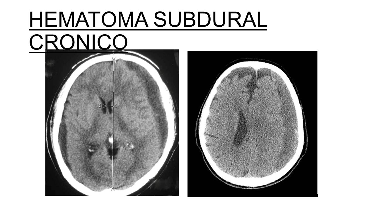 Cefalohematoma Download